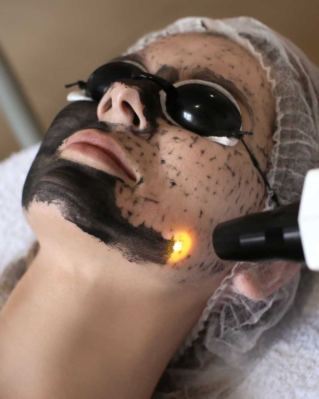 Q-Switch Laser treatment