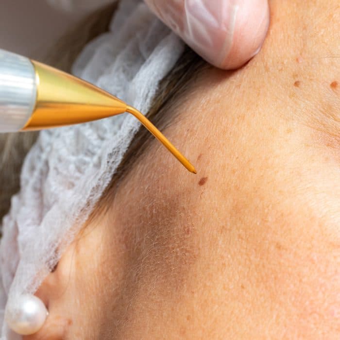Plasma Fibroblast treatment