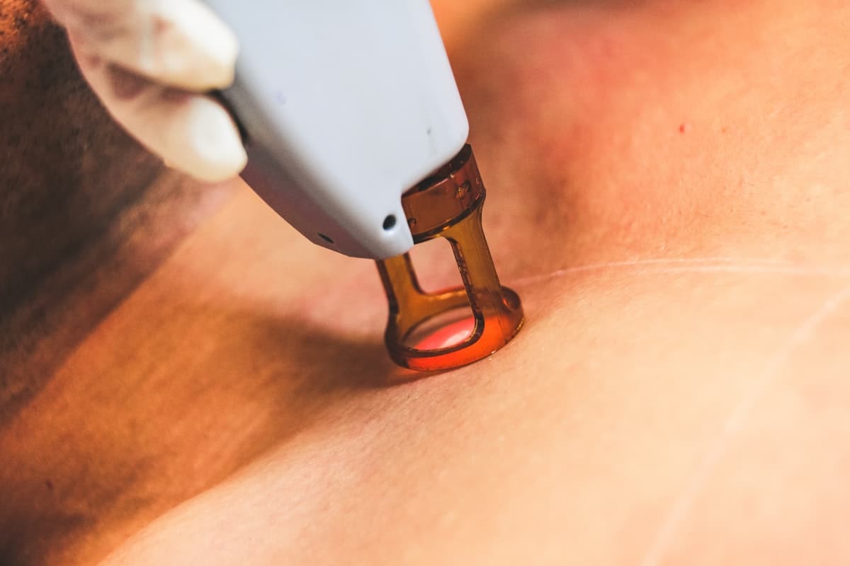 IPL hair removal. treatment
